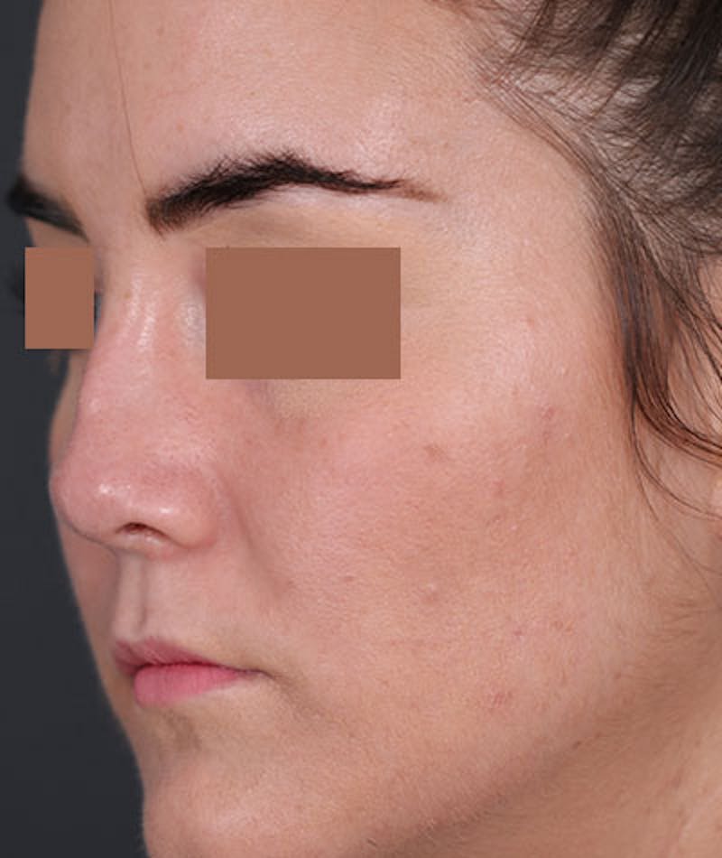 Primary Rhinoplasty Before & After Gallery - Patient 108174470 - Image 5