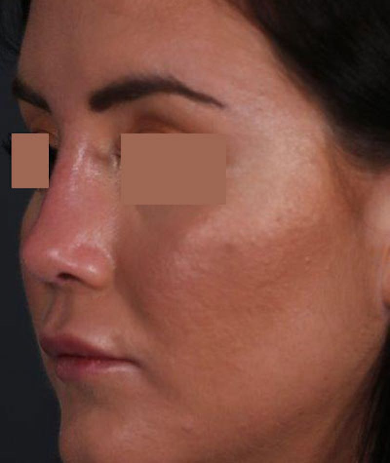 Primary Rhinoplasty Before & After Gallery - Patient 108174470 - Image 6