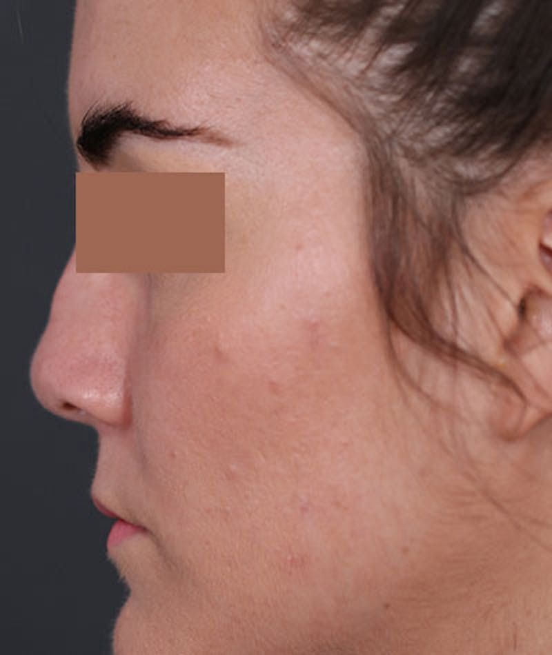 Primary Rhinoplasty Before & After Gallery - Patient 108174470 - Image 7