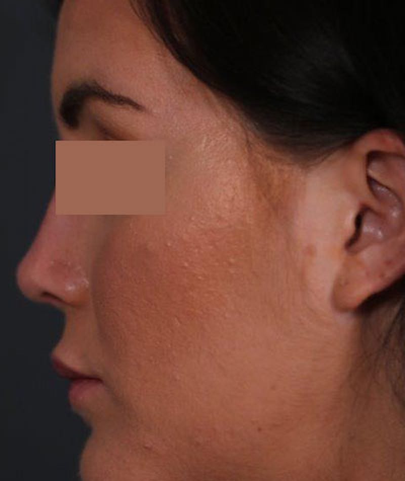 Primary Rhinoplasty Before & After Gallery - Patient 108174470 - Image 8
