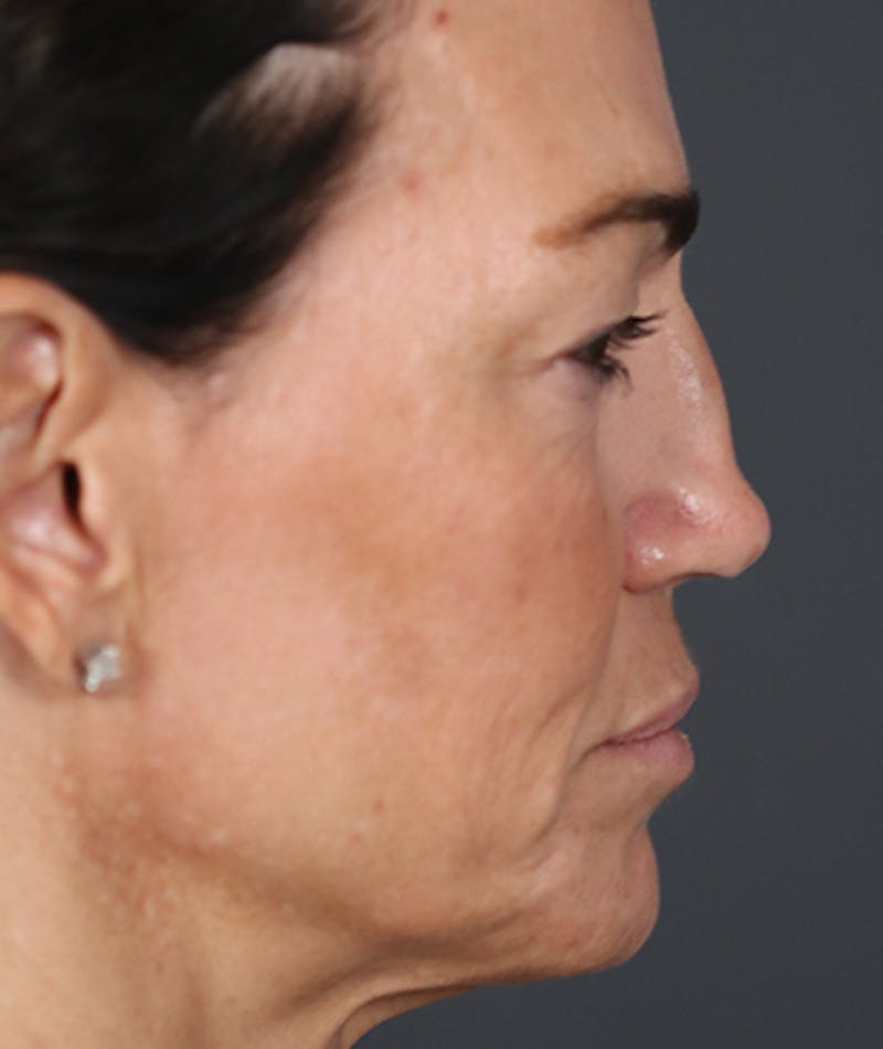 Primary Rhinoplasty Before & After Gallery - Patient 108174472 - Image 1