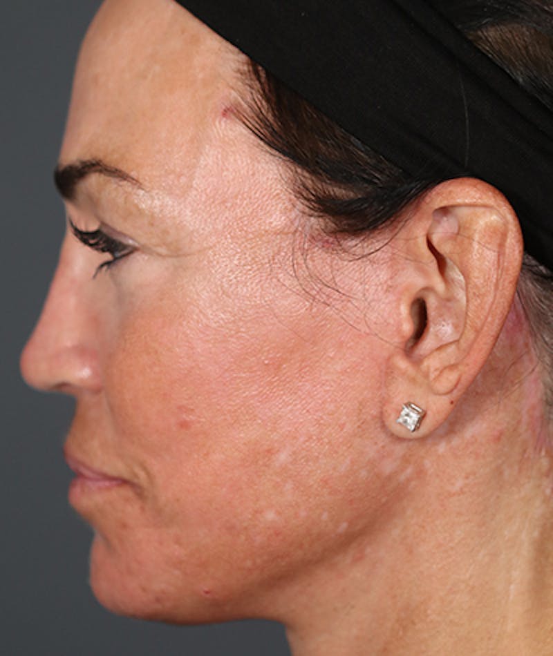 Primary Rhinoplasty Before & After Gallery - Patient 108174472 - Image 2