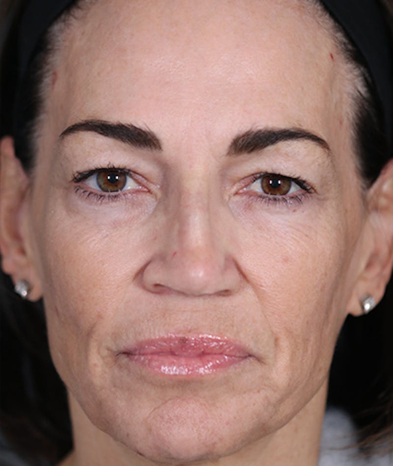 Primary Rhinoplasty Before & After Gallery - Patient 108174472 - Image 3