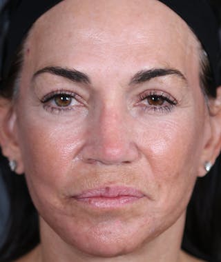 Primary Rhinoplasty Before & After Gallery - Patient 108174472 - Image 4