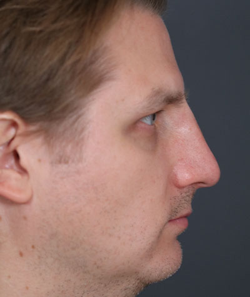 Primary Rhinoplasty Before & After Gallery - Patient 108174482 - Image 1