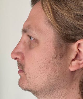 Primary Rhinoplasty Before & After Gallery - Patient 108174482 - Image 2