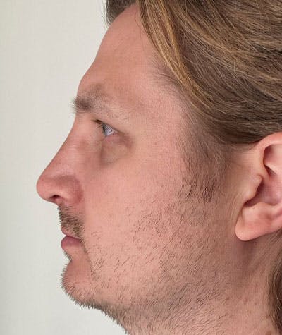 Primary Rhinoplasty Before & After Gallery - Patient 108174482 - Image 2