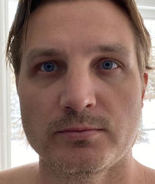 Primary Rhinoplasty Before & After Gallery - Patient 108174482 - Image 4