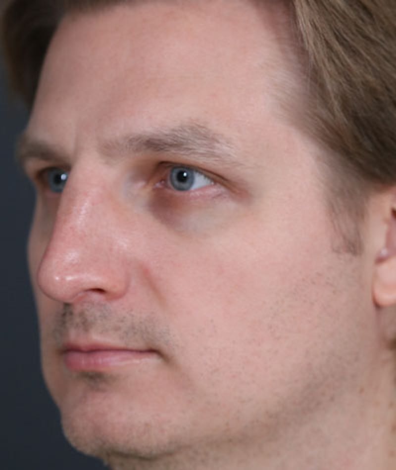 Primary Rhinoplasty Before & After Gallery - Patient 108174482 - Image 5