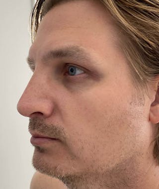 Primary Rhinoplasty Before & After Gallery - Patient 108174482 - Image 6