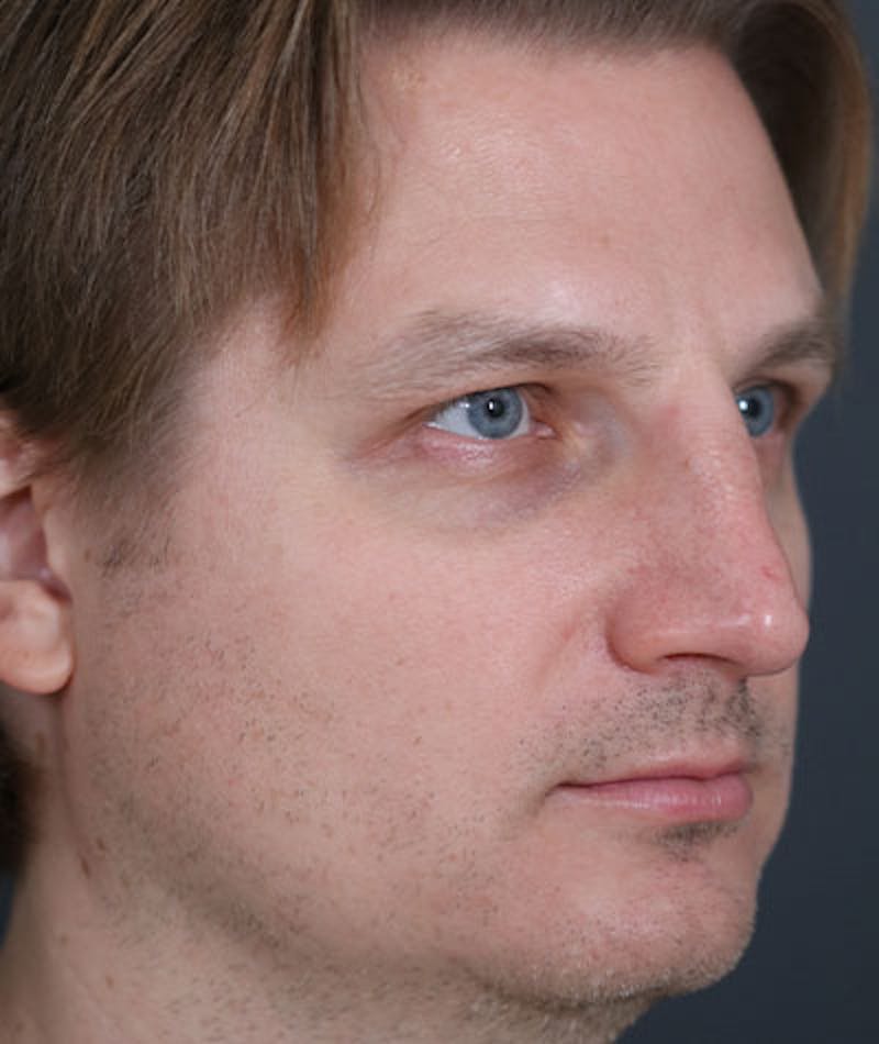 Primary Rhinoplasty Before & After Gallery - Patient 108174482 - Image 7