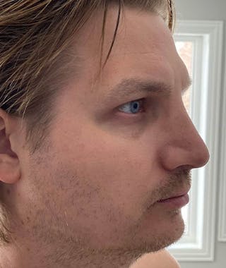 Primary Rhinoplasty Before & After Gallery - Patient 108174482 - Image 8