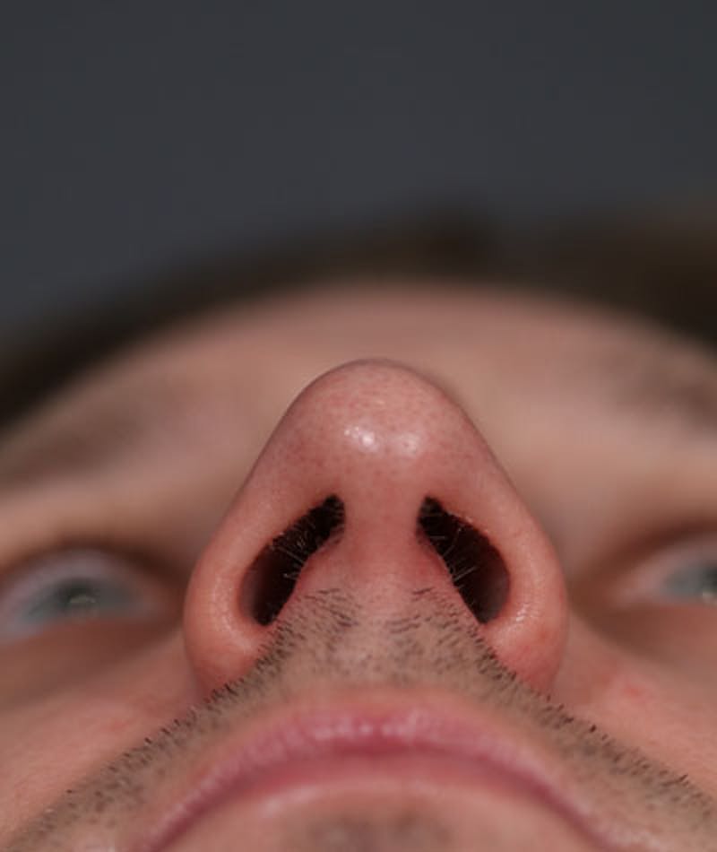 Primary Rhinoplasty Before & After Gallery - Patient 108174482 - Image 9