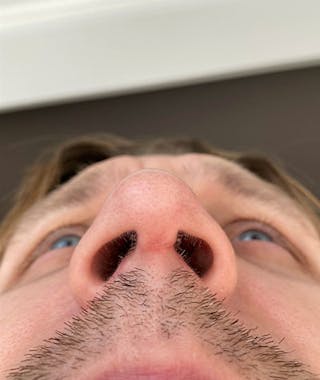 Primary Rhinoplasty Before & After Gallery - Patient 108174482 - Image 10