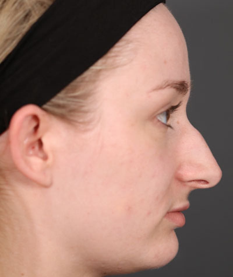 Primary Rhinoplasty Before & After Gallery - Patient 108174498 - Image 1