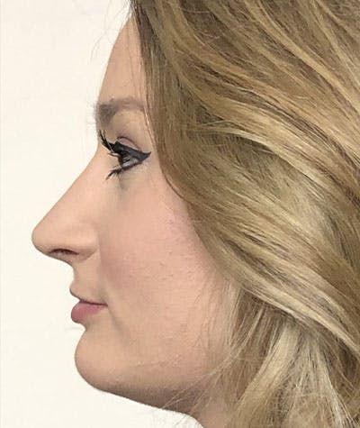 Primary Rhinoplasty Before & After Gallery - Patient 108174498 - Image 2