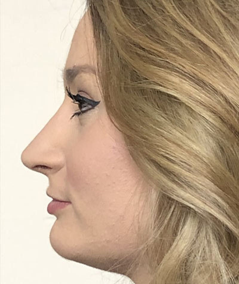 Primary Rhinoplasty Before & After Gallery - Patient 108174498 - Image 2
