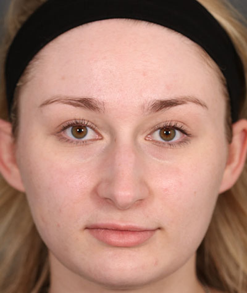 Primary Rhinoplasty Before & After Gallery - Patient 108174498 - Image 3