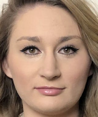 Primary Rhinoplasty Before & After Gallery - Patient 108174498 - Image 4