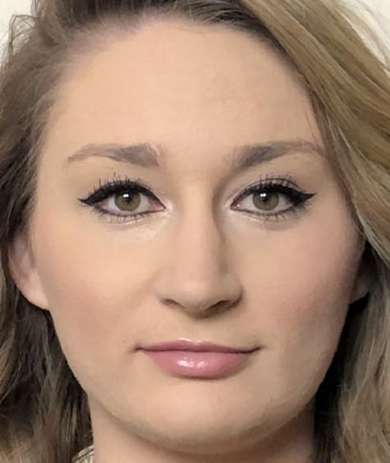 Primary Rhinoplasty Before & After Gallery - Patient 108174498 - Image 4