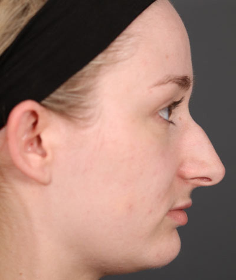 Primary Rhinoplasty Before & After Gallery - Patient 108174498 - Image 5