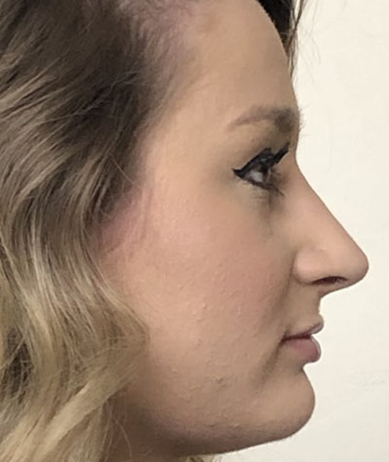 Primary Rhinoplasty Before & After Gallery - Patient 108174498 - Image 6
