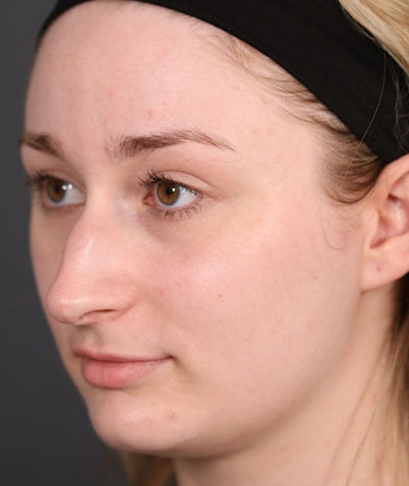 Primary Rhinoplasty Before & After Gallery - Patient 108174498 - Image 7
