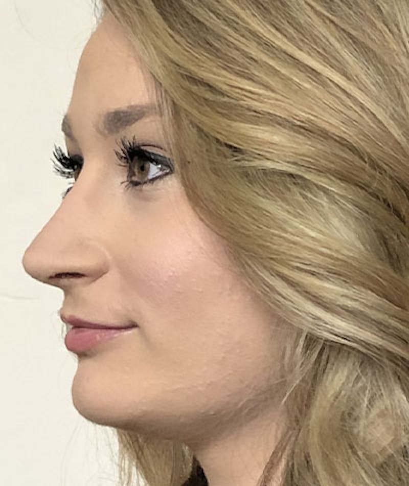 Primary Rhinoplasty Before & After Gallery - Patient 108174498 - Image 8