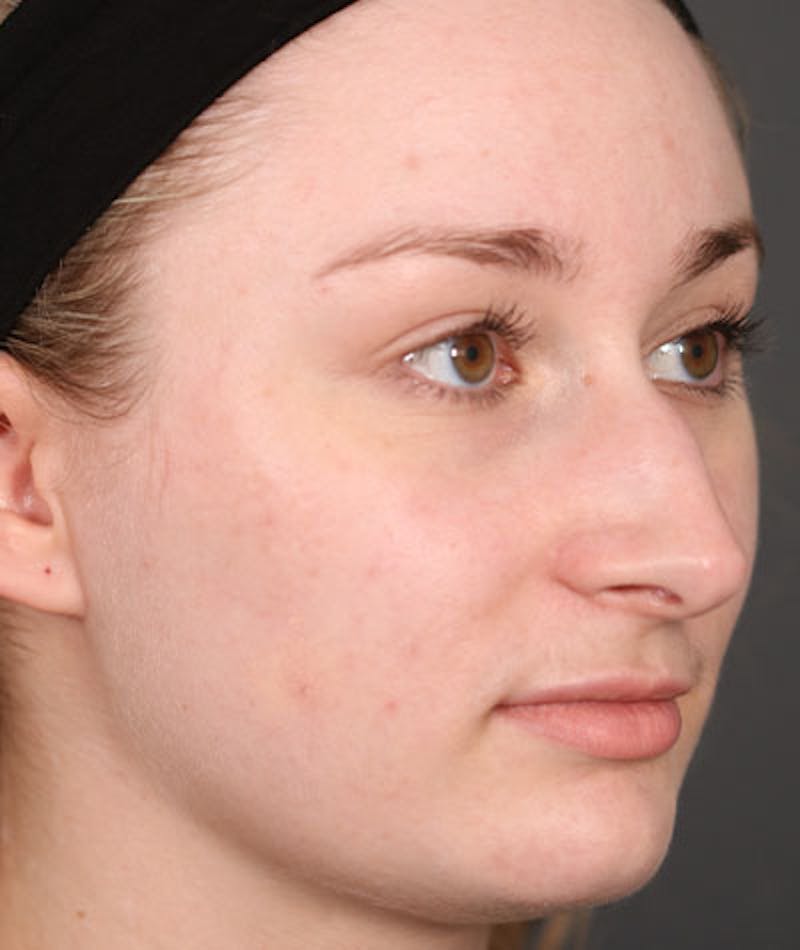 Primary Rhinoplasty Before & After Gallery - Patient 108174498 - Image 9