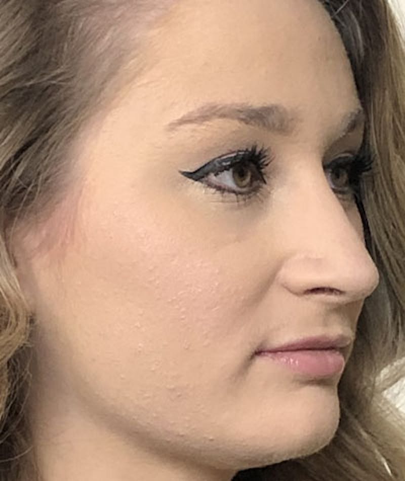 Primary Rhinoplasty Before & After Gallery - Patient 108174498 - Image 10