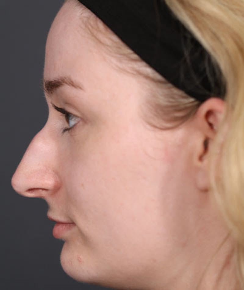 Primary Rhinoplasty Before & After Gallery - Patient 108174498 - Image 11