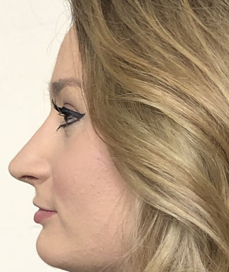 Primary Rhinoplasty Before & After Gallery - Patient 108174498 - Image 12