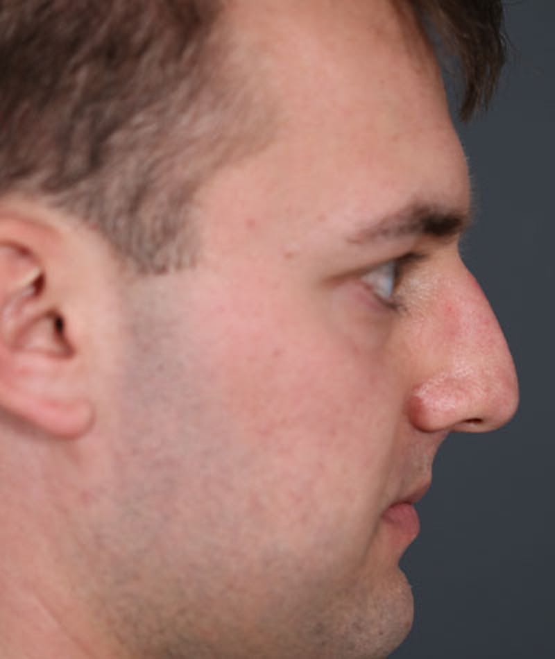 Primary Rhinoplasty Before & After Gallery - Patient 108174500 - Image 1