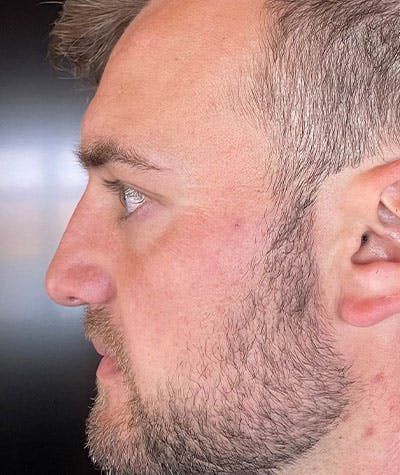 Primary Rhinoplasty Before & After Gallery - Patient 108174500 - Image 2