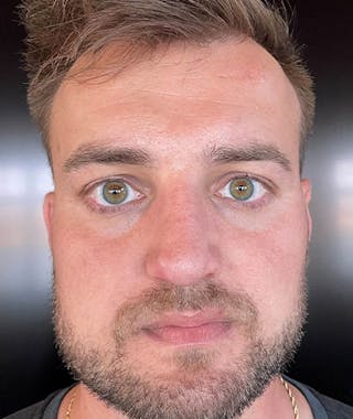 Primary Rhinoplasty Before & After Gallery - Patient 108174500 - Image 4
