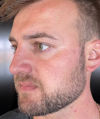 Primary Rhinoplasty Before & After Gallery - Patient 108174500 - Image 6