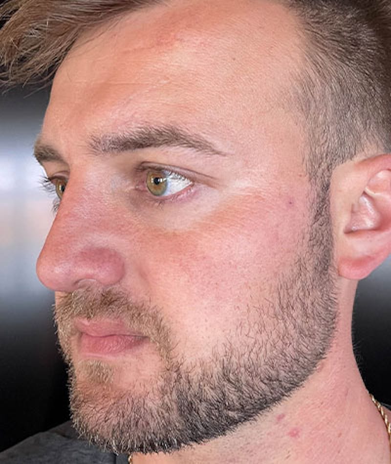 Primary Rhinoplasty Before & After Gallery - Patient 108174500 - Image 6