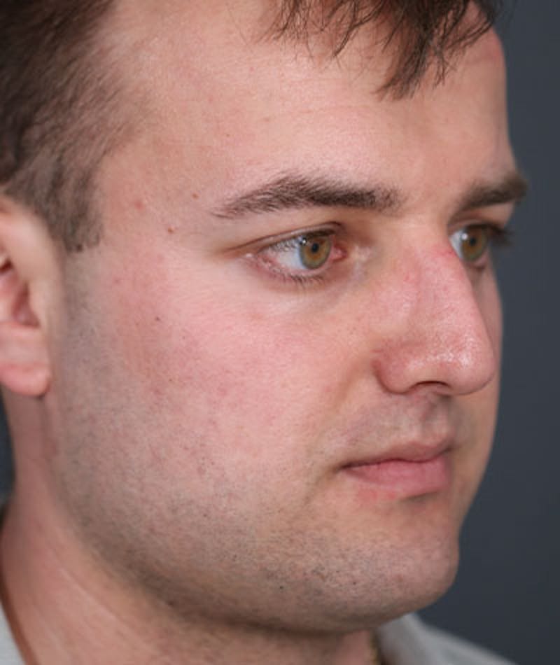 Primary Rhinoplasty Before & After Gallery - Patient 108174500 - Image 7
