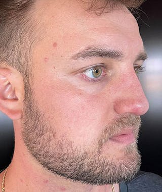 Primary Rhinoplasty Before & After Gallery - Patient 108174500 - Image 8