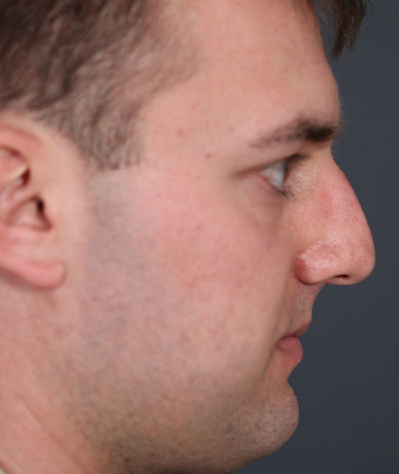 Primary Rhinoplasty Before & After Gallery - Patient 108174500 - Image 9