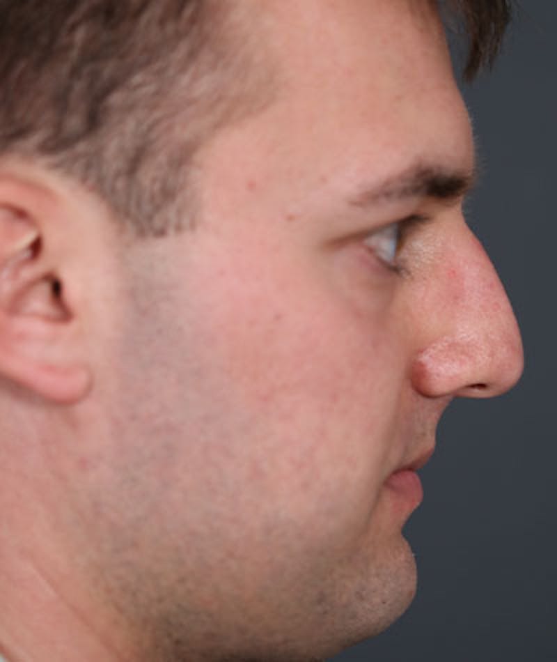 Primary Rhinoplasty Before & After Gallery - Patient 108174500 - Image 9