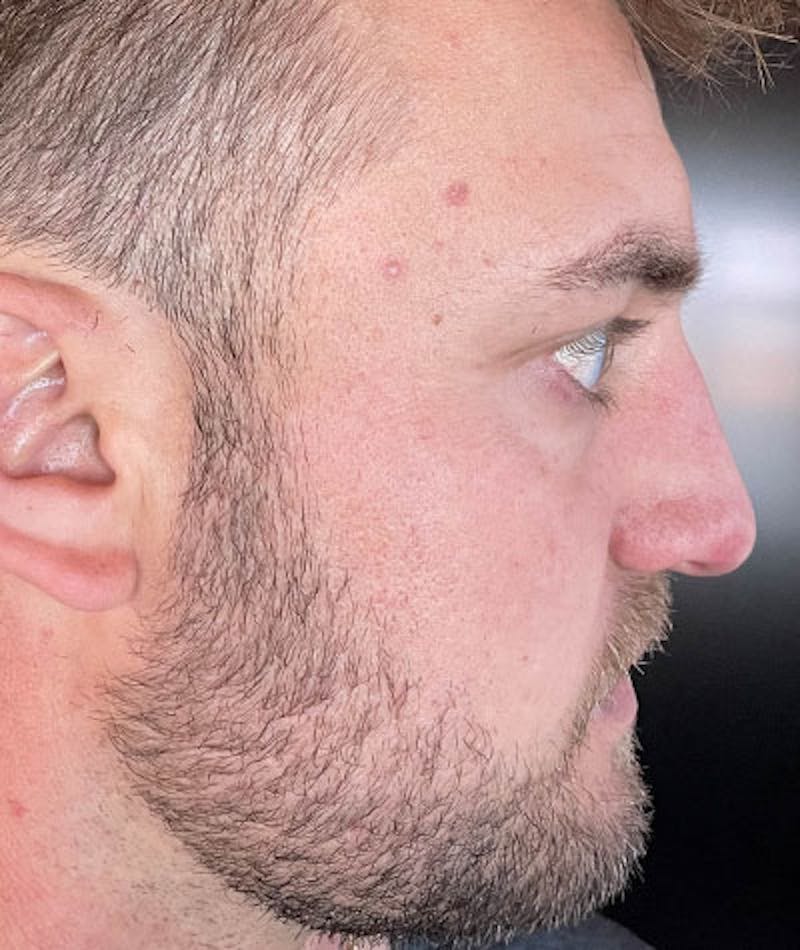 Primary Rhinoplasty Before & After Gallery - Patient 108174500 - Image 10