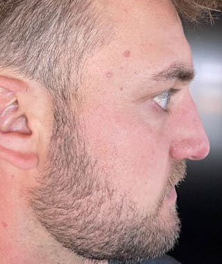 Primary Rhinoplasty Before & After Gallery - Patient 108174500 - Image 10