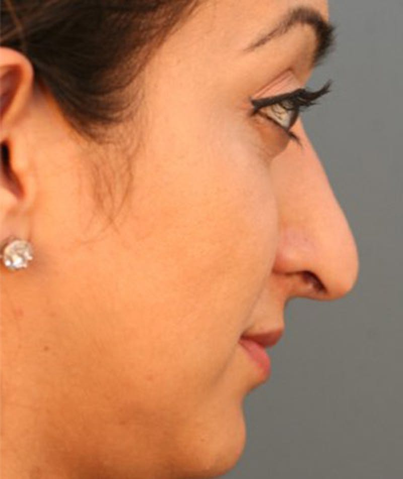 Ethnic Rhinoplasty Before & After Gallery - Patient 108174649 - Image 1