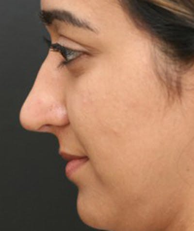 ethnic nose job uk