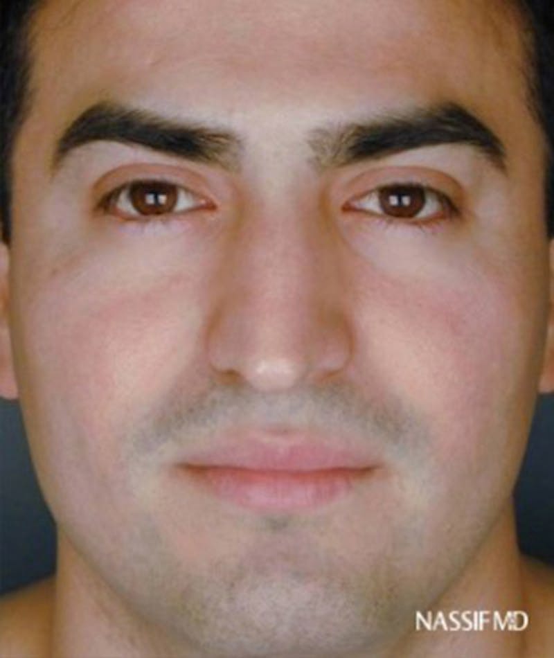 Ethnic Rhinoplasty Before & After Gallery - Patient 108174687 - Image 3