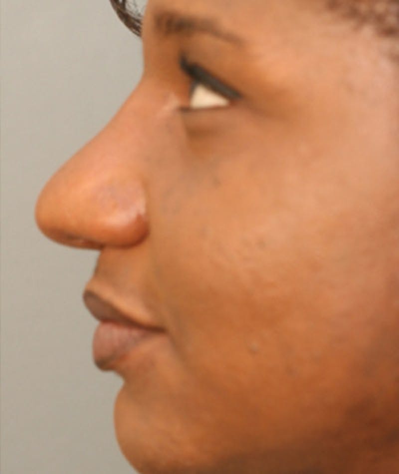 Ethnic Rhinoplasty Before & After Gallery - Patient 108174689 - Image 2
