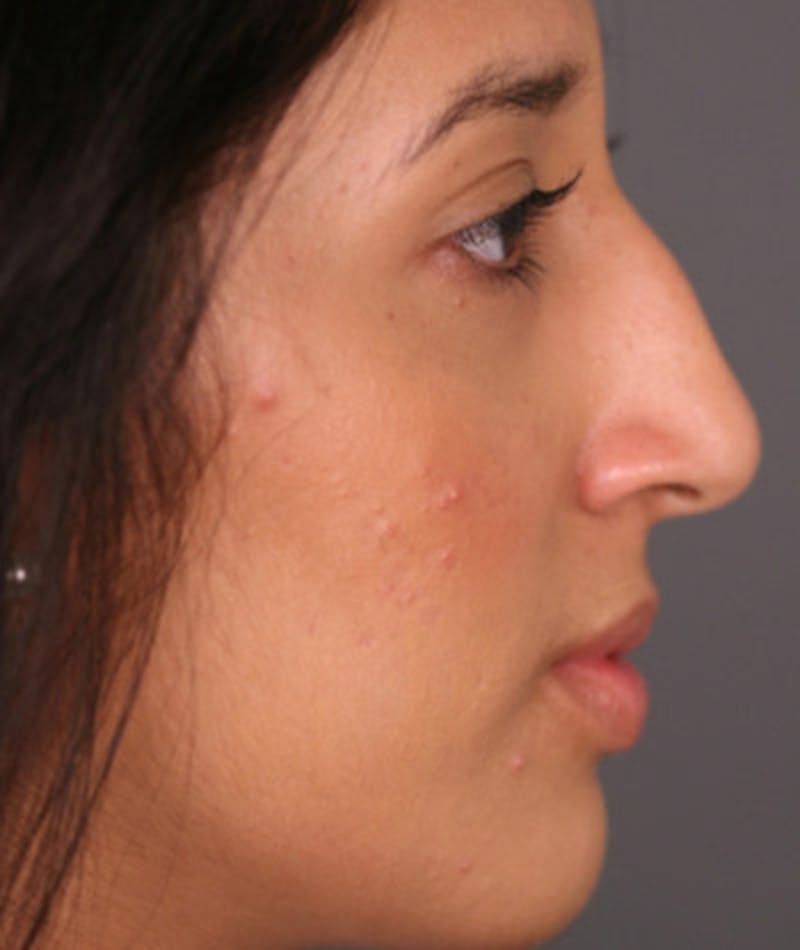 Ethnic Rhinoplasty Before & After Gallery - Patient 108174691 - Image 1