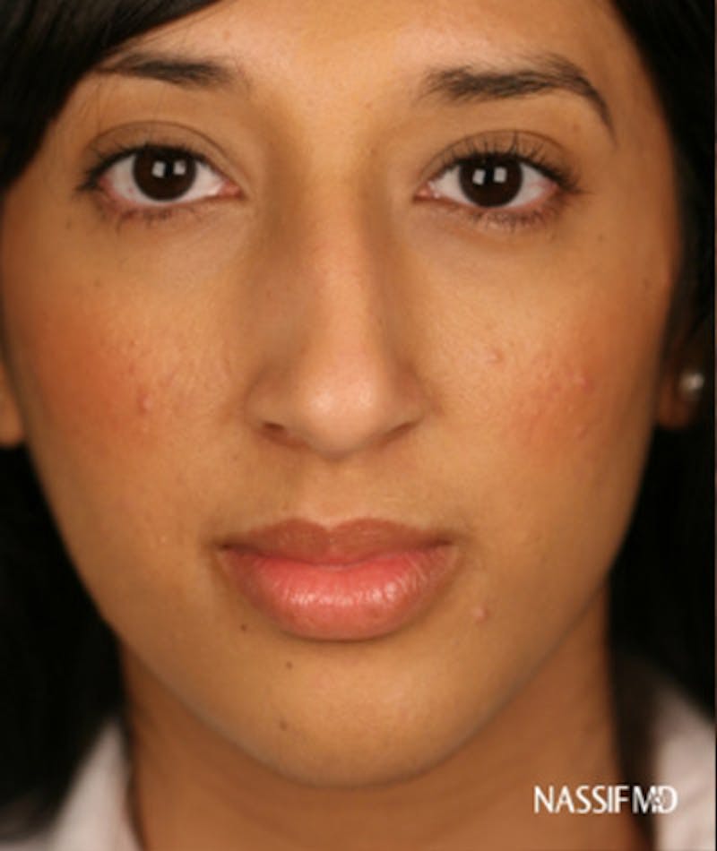 Ethnic Rhinoplasty Before & After Gallery - Patient 108174691 - Image 3