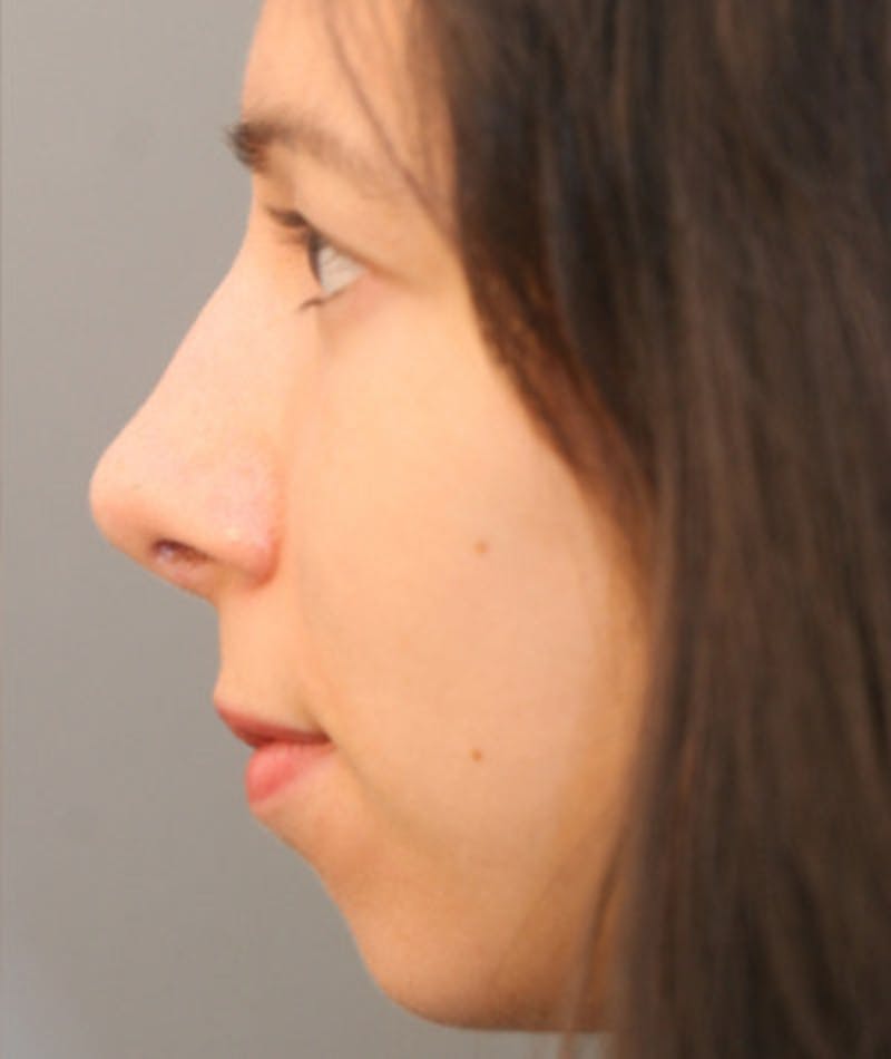 Ethnic Rhinoplasty Before & After Gallery - Patient 108174692 - Image 2